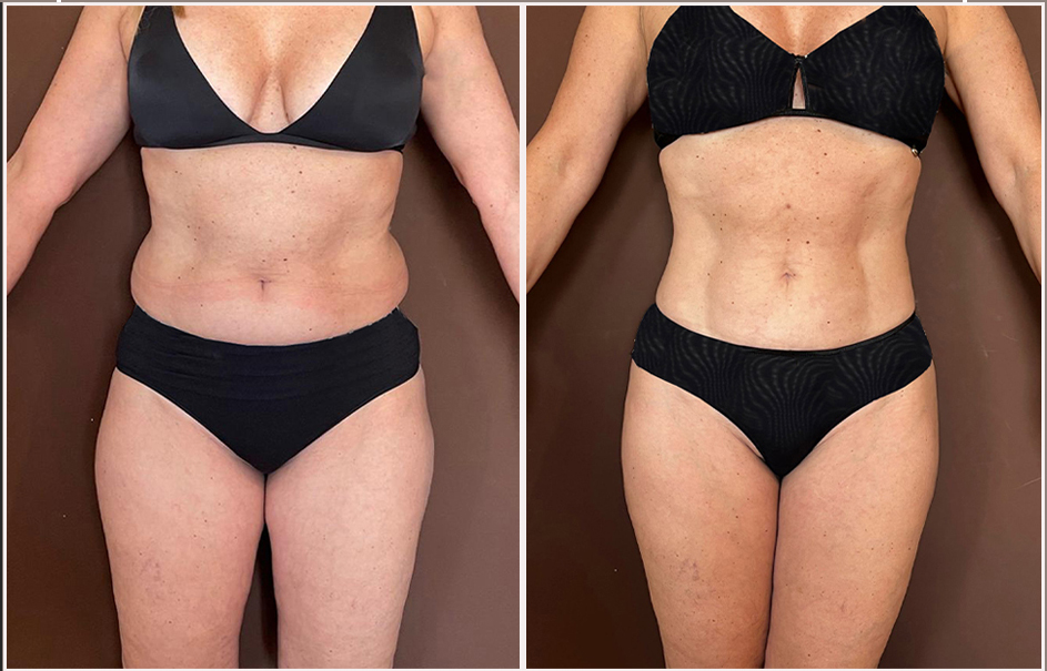 Abdominoplastia Cirujano Pl stico